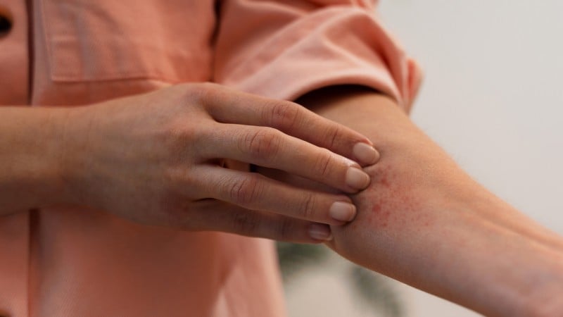 União cita custo alto, enquanto casos crescem e pressionam o sistema de saúde.